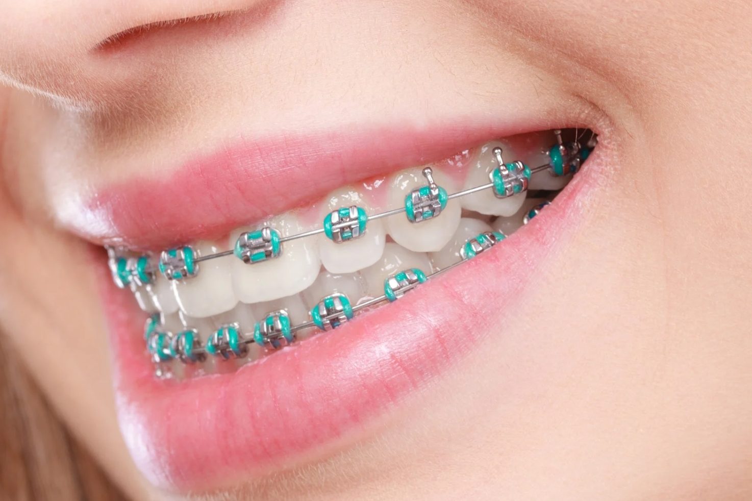 Clinica Dental Puebla - Ortodoncia Puebla Ortodoncia, Brackets, Dentista ortodoncista en Puebla